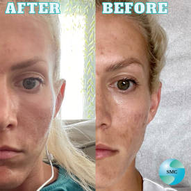 Acne BeforeAfter