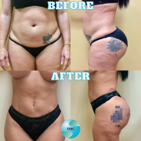 Lipo-Body-BeforeAfter-1