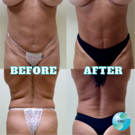 Lipo-Body-BeforeAfter-11