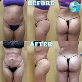 Lipo-Body-BeforeAfter-2