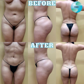 Lipo-Body-BeforeAfter-3