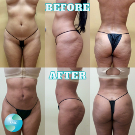 Lipo-Body-BeforeAfter-5