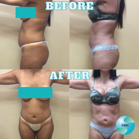 Lipo-Body-BeforeAfter-9