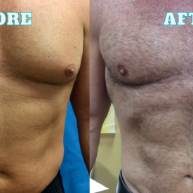 Lipo BeforeAfter 3