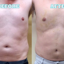 Lipo BeforeAfter 4