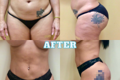 Lipo-Body-BeforeAfter-1