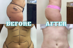 Lipo-Body-BeforeAfter-10