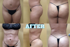 Lipo-Body-BeforeAfter-2
