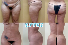 Copy of Lipo Body BeforeAfter 8