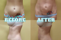 Lipo-Body-BeforeAfter-6
