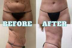 Lipo-Body-BeforeAfter-8