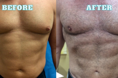 Lipo BeforeAfter 3