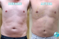 Lipo BeforeAfter 4