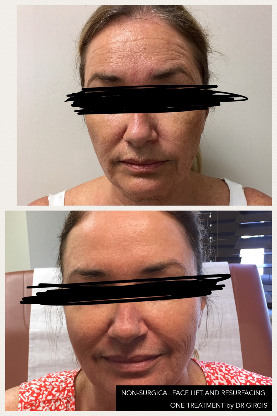 Woman before and after non-surgical facelift