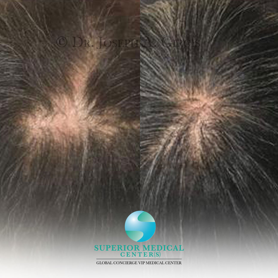 Platelet and Plasma for Scalp Rejuvenation and Hair Regrowth after 2 treatments