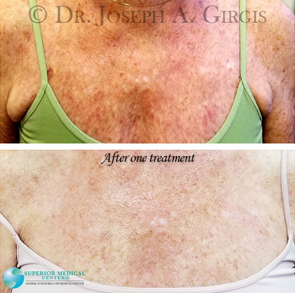 Sun Damage and Dark Spot Removal after 1 treatment